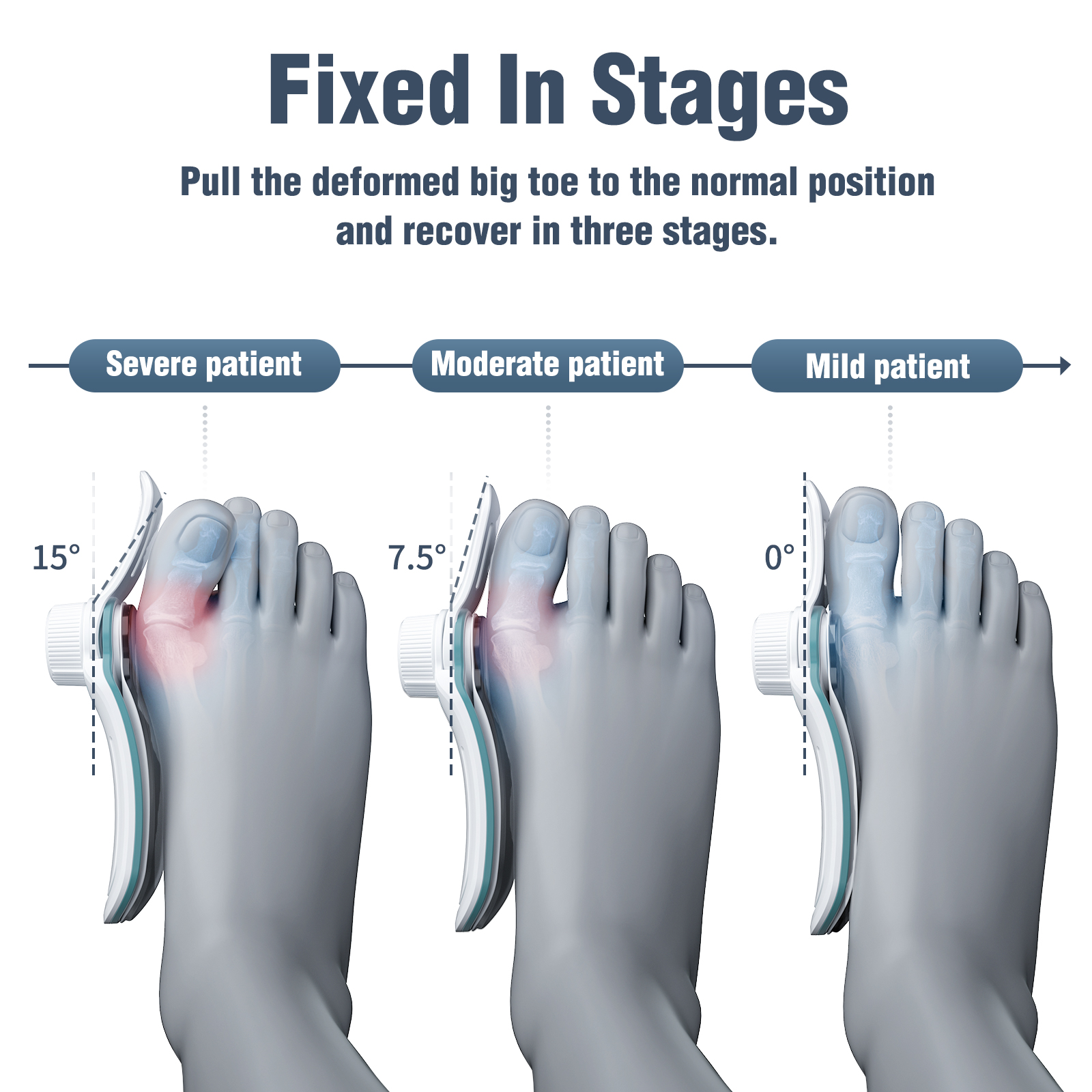 Tenicore Easy Replacement Three Fixing Plates Rotate 129 Degrees Barrier-free Walking Hallux Valgus Bunion Corrector